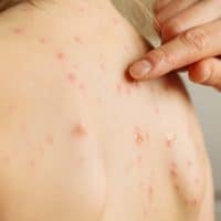 morbillo-rosolia